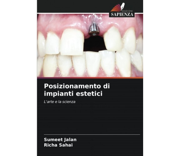 Posizionamento di impianti estetici: L'arte e la scienza - Sumeet Jalan - 2022